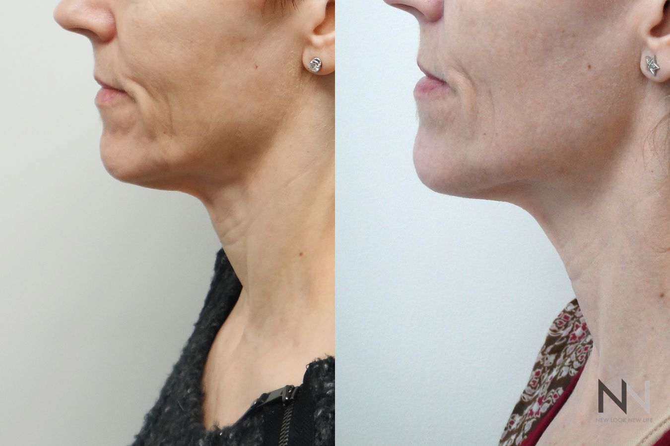 Before and after Ultherapy case 21289