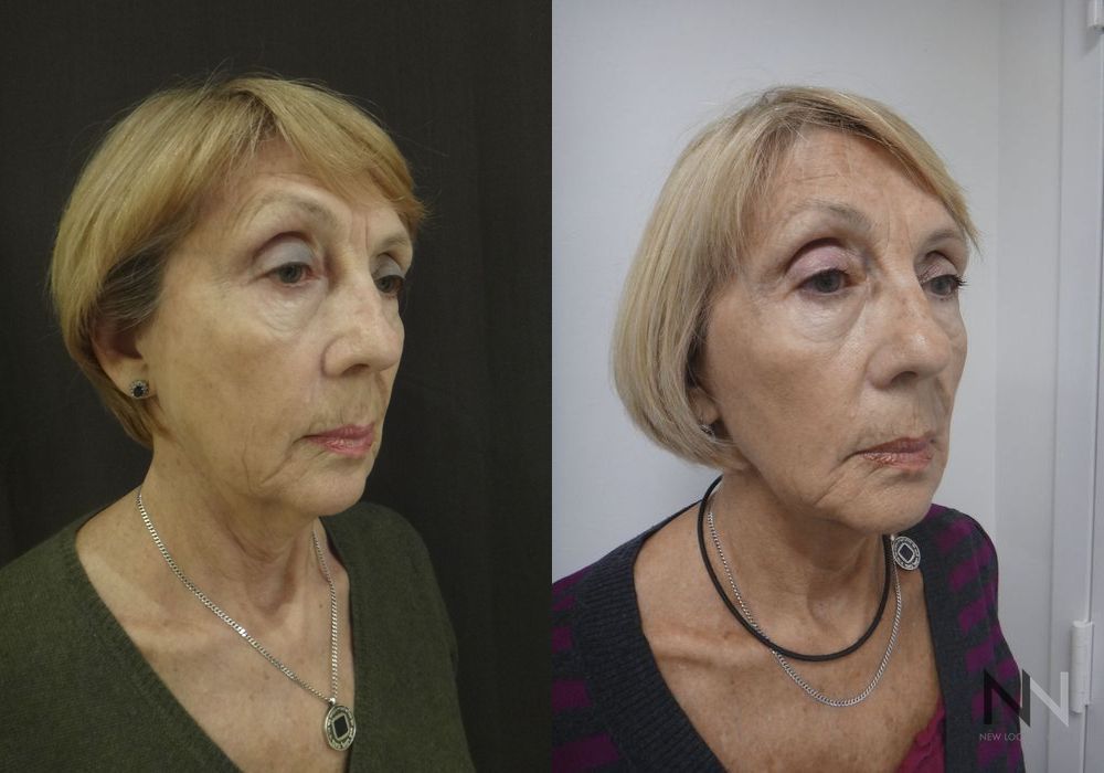 Ultherapy - Thumbnail 2