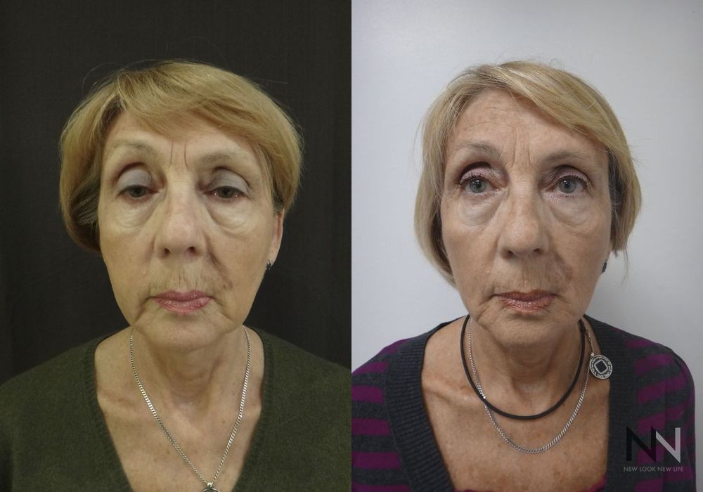 Ultherapy - Case 1744