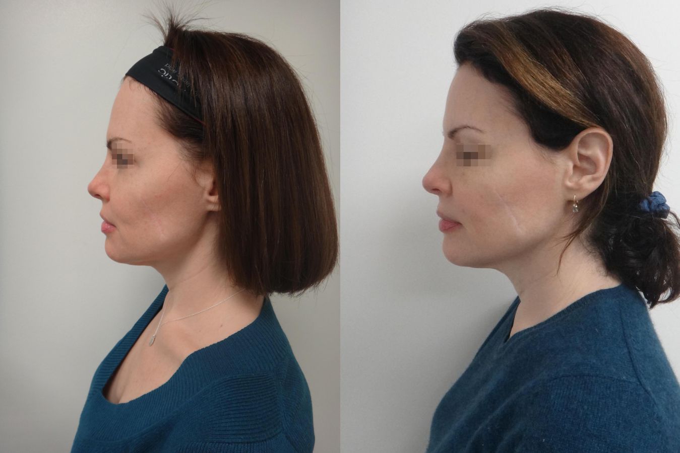 Lift & Tighten Naturally - Angle 2