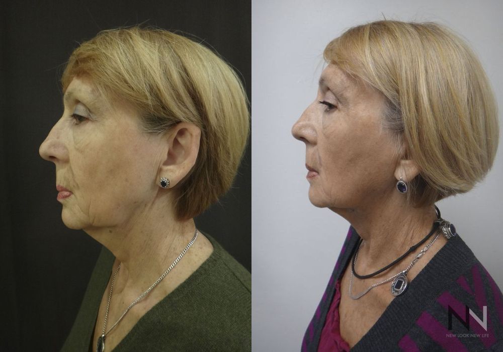 Ultherapy - Thumbnail 5