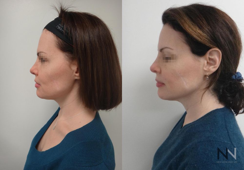 Ultherapy - Thumbnail 2