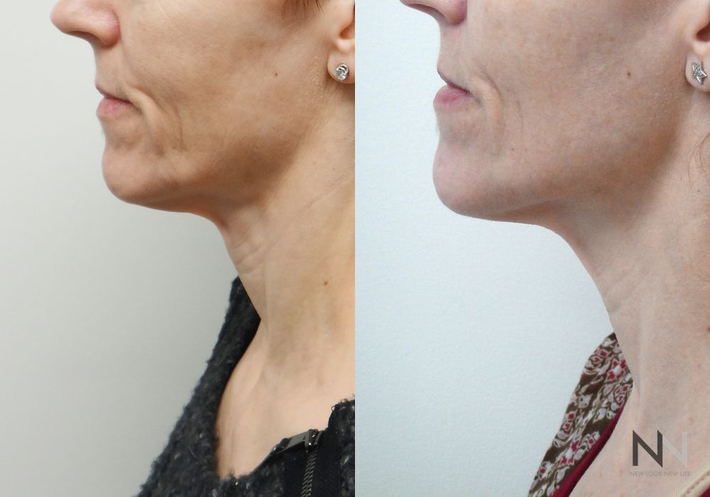 Ultherapy - Case 1743