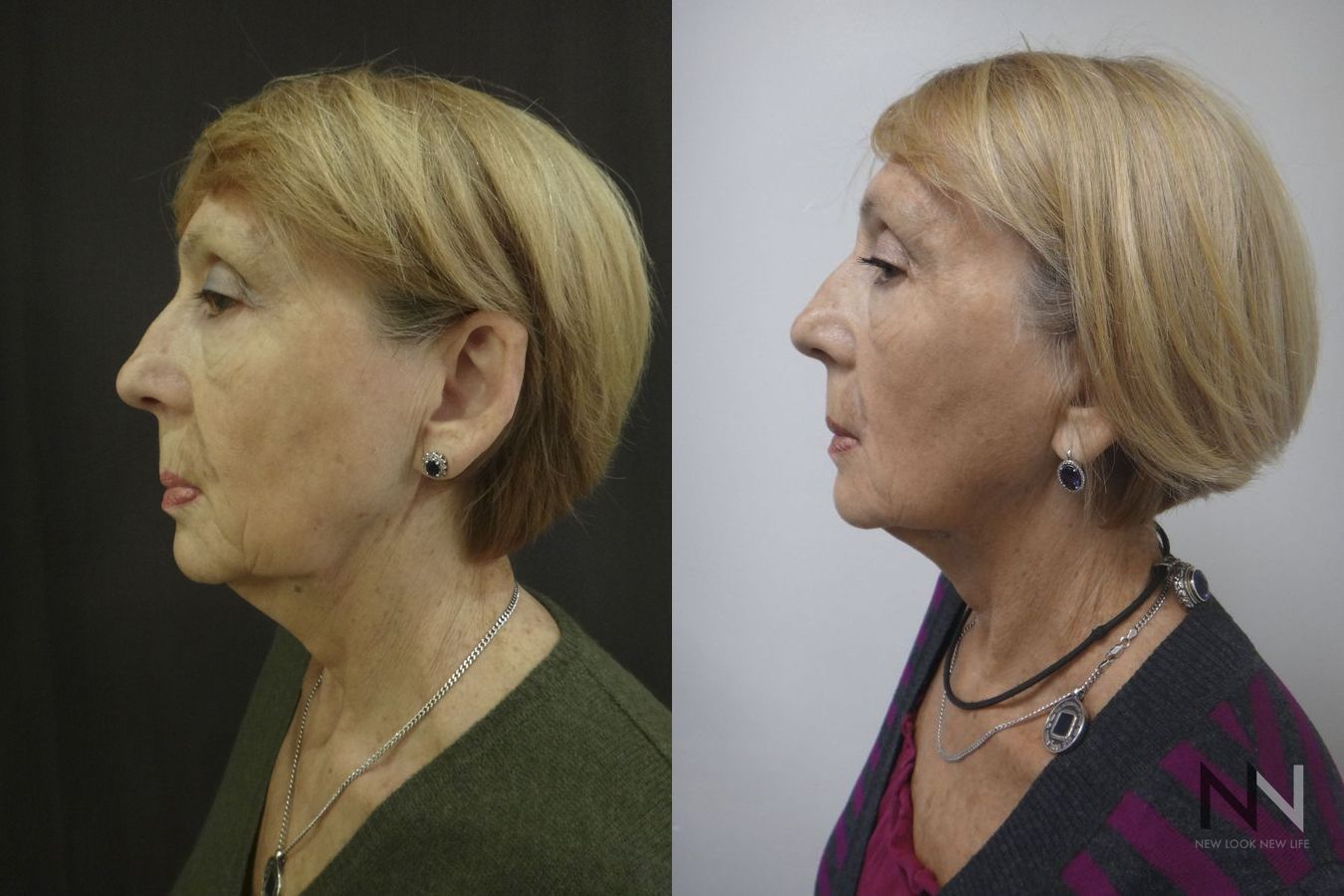 Before and after Ultherapy case 21295 - Angle 5