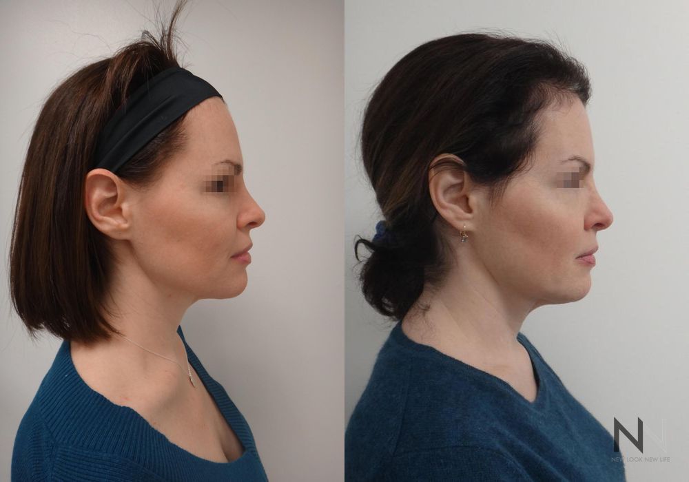 Ultherapy - Case 2276