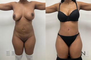 Abdominoplasty and liposuction showing improved contour - Angle 1
