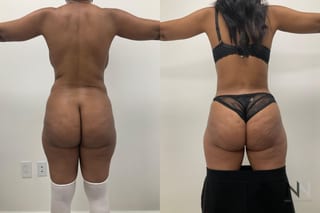 Abdominoplasty and liposuction showing improved contour - Angle 2