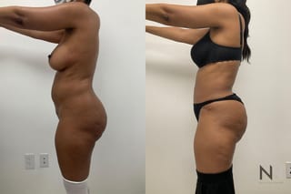 Abdominoplasty and liposuction showing improved contour - Angle 3