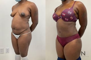 Before and after tummy tuck with liposuction six months - Angle 2