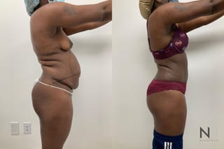 Before and after tummy tuck with liposuction six months - Angle 3
