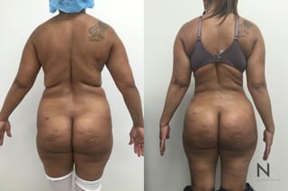 Before and after BBL with Lipo 360 showing reduced waist size and enhanced buttock projection six months after surgery. - Angle 2
