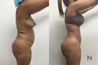 Before and after BBL with Lipo 360 showing reduced waist size and enhanced buttock projection six months after surgery. - Angle 1