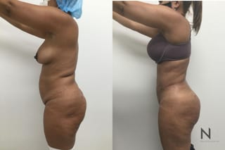 Before and after BBL with Lipo 360 showing reduced waist size and enhanced buttock projection six months after surgery. - Angle 3