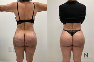 Before and after Brazilian Butt Lift showing enhanced buttock volume and improved projection six months after surgery. - Angle 1