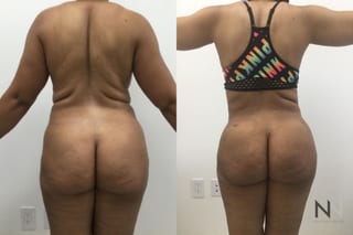 BBL showing increased buttock volume and contour - Angle 1