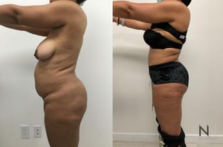 BBL showing increased buttock volume and contour - Angle 2