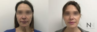 Before and after facelift with fat grafting results - Angle 1