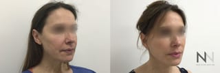 Before and after facelift with fat grafting results - Angle 2
