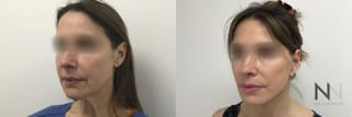Before and after facelift with fat grafting results - Angle 3