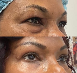 Before and after upper and lower blepharoplasty three months results - Angle 1