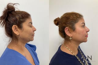 Jawline contour improvement after chin liposuction - Angle 1