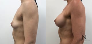 Before and after breast augmentation six months results - Angle 1