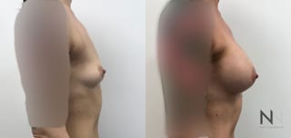 Before and after breast augmentation six months results - Angle 2