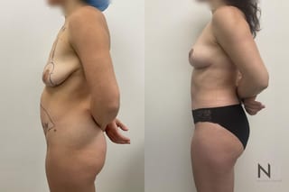 Before and after mommy makeover six months results - Angle 2