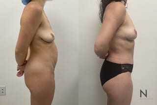 Before and after mommy makeover six months results - Angle 3