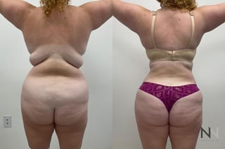 Abdominal contour improvement after mommy makeover - Angle 2