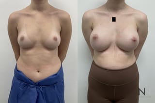 Before and after breast augmentation saline implants six months - Angle 1