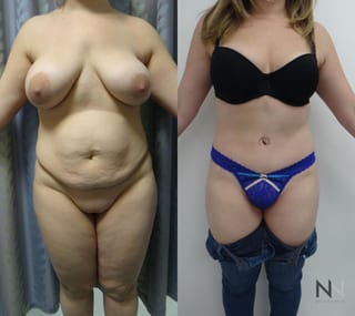Midsection contour refinement after abdominoplasty - Angle 1