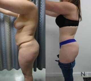 Midsection contour refinement after abdominoplasty - Angle 2