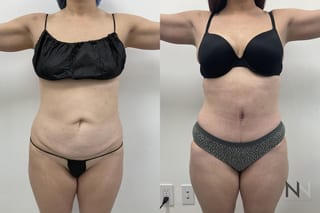 Waistline definition after abdominoplasty procedure - Angle 1