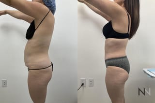 Waistline definition after abdominoplasty procedure - Angle 2