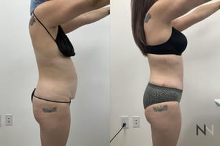 Waistline definition after abdominoplasty procedure - Angle 4