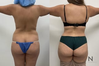 Before and after tummy tuck with flank liposuction - Angle 4