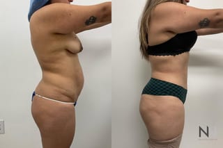 Before and after tummy tuck with flank liposuction - Angle 2
