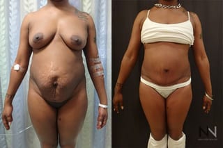 Tummy tuck before and after abdominal contour improvement - Angle 1