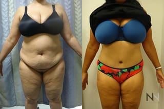 Before and after tummy tuck eight months results - Angle 1
