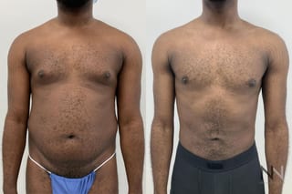 Gynecomastia surgery with Lipo 360 torso contour improvement - Angle 1