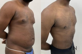 Gynecomastia surgery with Lipo 360 torso contour improvement - Angle 3