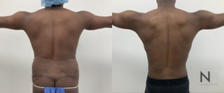 Gynecomastia surgery with Lipo 360 torso contour improvement - Angle 5