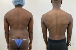 Gynecomastia surgery with Lipo 360 torso contour improvement - Angle 7