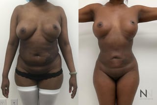 Before and after Lipo 360 six months results - Angle 1