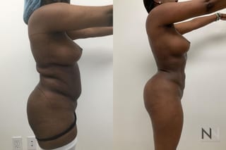 Before and after Lipo 360 six months results - Angle 4