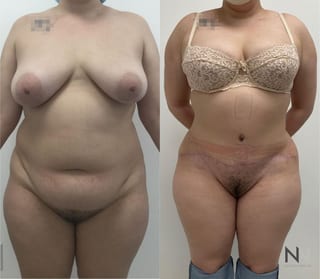 Liposuction 360 showing improved waist and flank contour - Angle 1