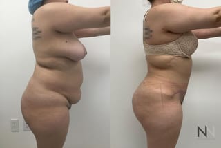 Liposuction 360 showing improved waist and flank contour - Angle 2