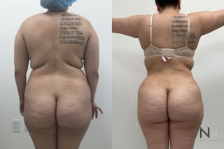 Liposuction 360 showing improved waist and flank contour - Angle 3