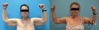 Upper arm tightening after brachioplasty surgery - Angle 1